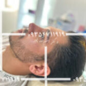 آموزش چسب بینی دکتر اسدالله پور+ویدیو