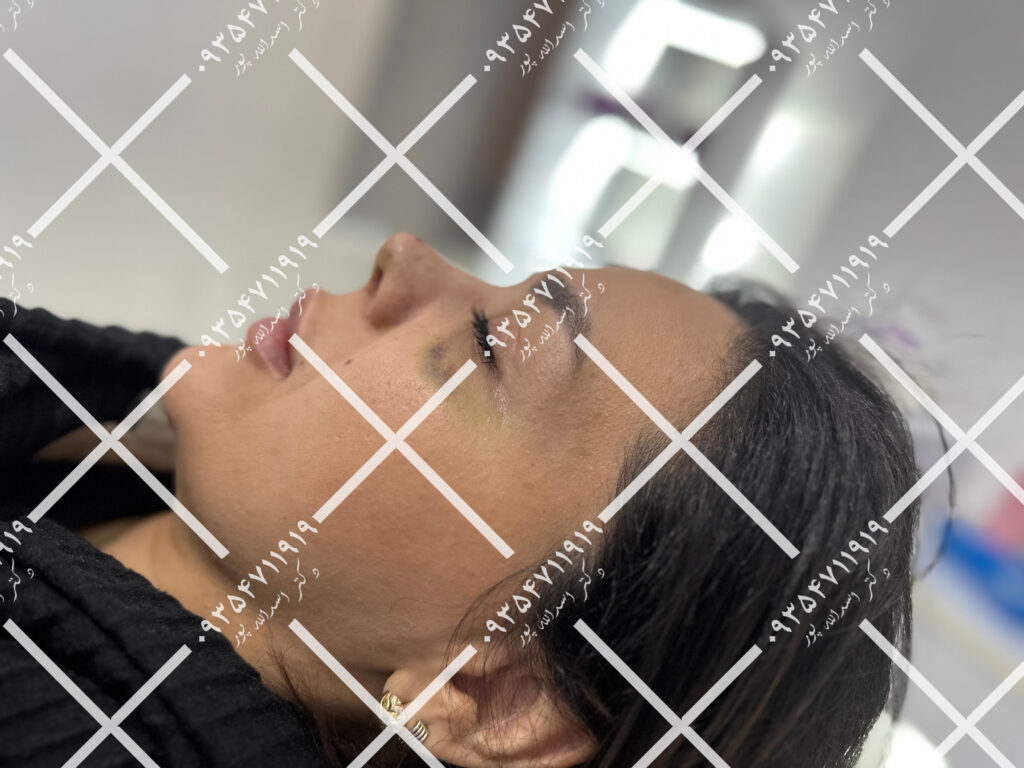 چسب بینی دکتر اسدالله پور